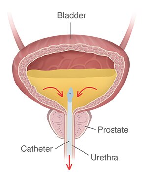 A bladder filled with urine, and a catheter inserted through the urethra and into the bladder, with arrows showing the flow of urine out of the bladder through the catheter.