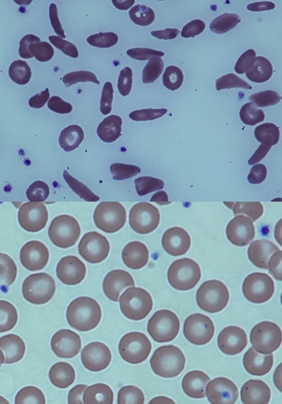 Photo of Blood drawn from a sickle cell patient and a sickle cell patient after stem cell transplant