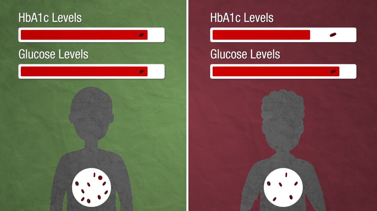 Video still depicting lower levels of HbA1c levels in individuals with G6PD deficiency. Accessible description available below.