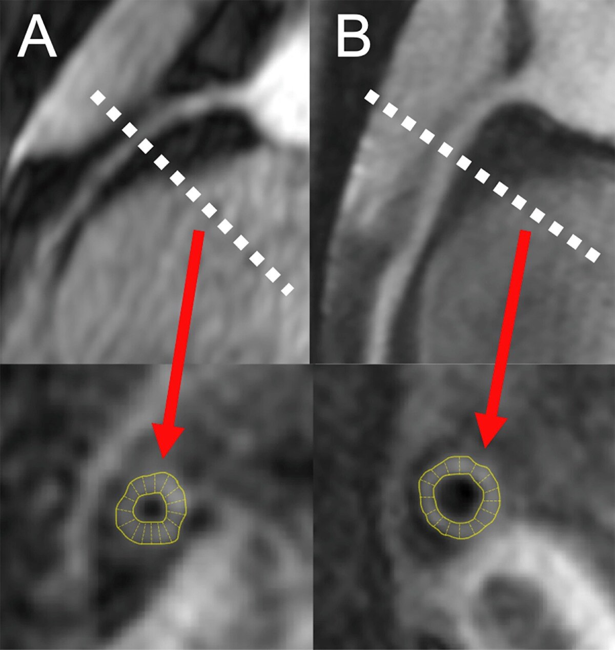 Magnetic resonance angiograms of right coronary arteries in two people living with HIV comparing coronary wall thickness.