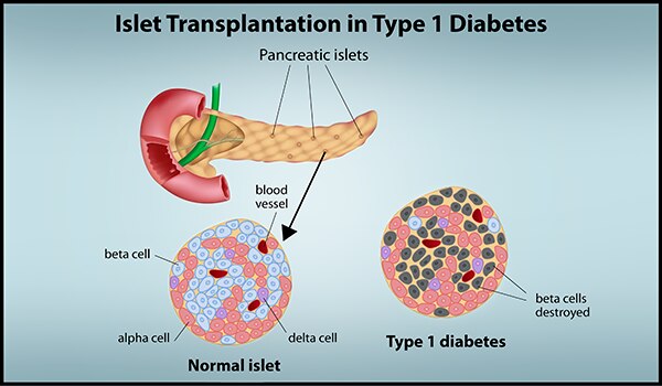 Faded blue background with title, “Islet Transplantation in Type 1 Diabetes”. Image of Pancreas with pancreatic islets emphasized and an arrow pointing to a normal islet microscopic image on the left side. The normal islet features the beta, alpha and delta cells as well as the blood vessels in blue, light red, purple and dark red colors, respectively. Next to this image is another microscopic image of type 1 diabetes in an islet cell. This image shows the beta cells destroyed in a gray color.