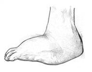 Illustration of Charcot’s foot showing an enlarged sole of the foot with a rounded shape.