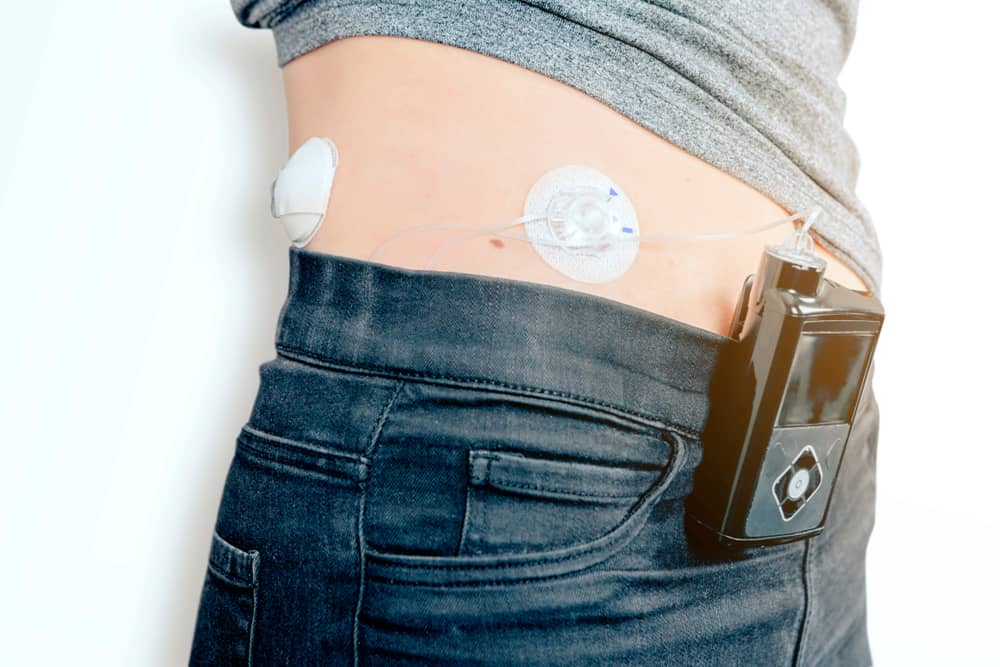 Una mujer lleva un monitor continuo de glucosa en la cintura de sus jeans. El sensor y la aguja están fijados a su abdomen.