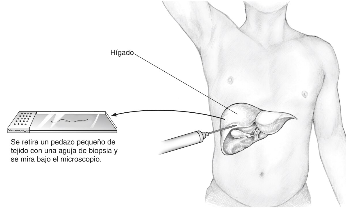 Ilustración de una biopsia del hígado percutánea, que muestra el hígado dentro de un torso humano, una aguja insertada en el abdomen y un portaobjetos.