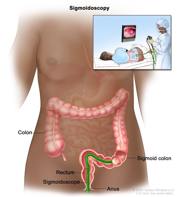 A sigmoidoscope inserted in the anus, rectum, and lower colon. An inset shows a health care professional performing a flexible sigmoidoscopy and a patient on their side.