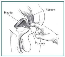 Cross-section diagram of a digital rectal exam, showing the physician’s gloved index finger inserted into the rectum to feel the size and shape of the prostate. The bladder, rectum, and prostate are labeled.