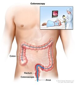 Illustration of a torso and over top of that illustration, an illustration of a doctor conducting a colonoscopy