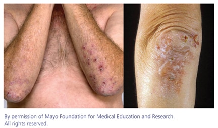 Two photographs of skin lesions caused by dermatitis herpetiformis.