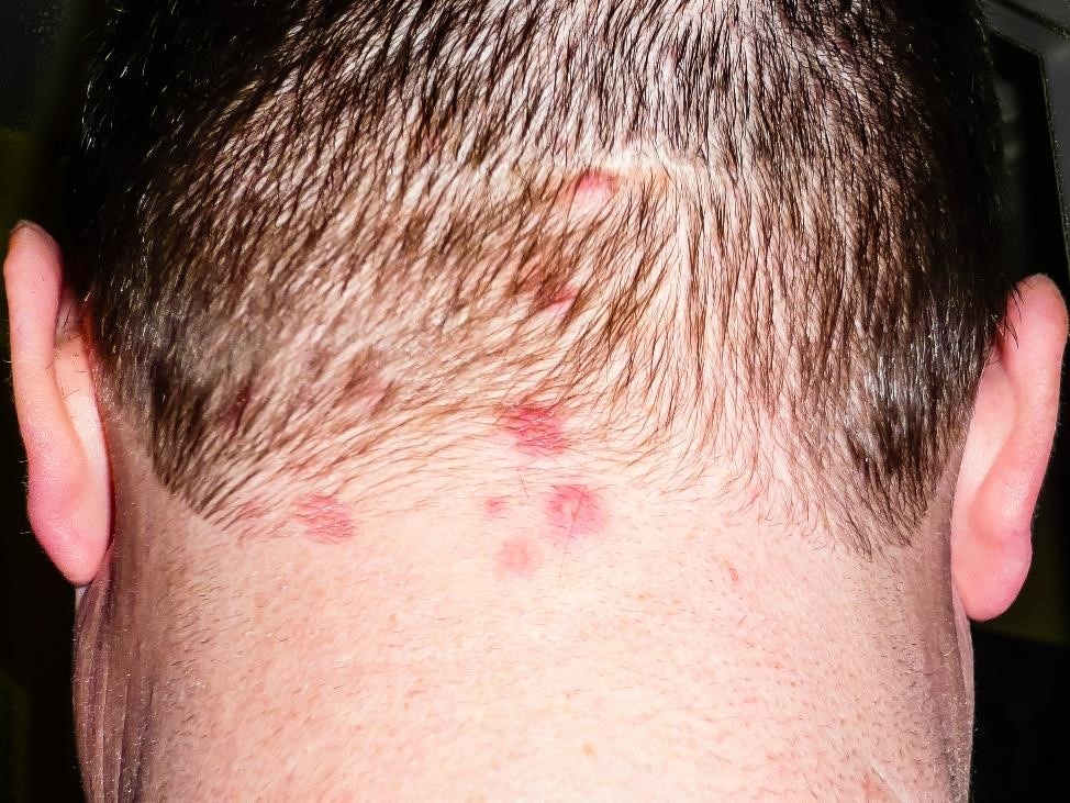 Erupción de dermatitis herpetiforme en la parte de atrás del cuero cabelludo de una persona.