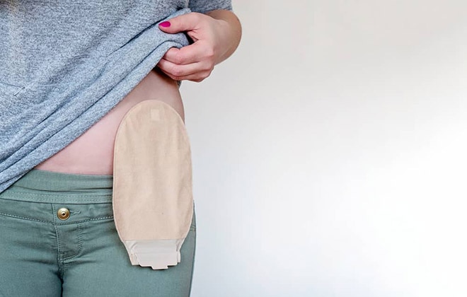 An ostomy pouch hangs from a stoma on one side of the belly.