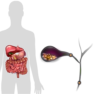An illustration of a human silhouette with a gallbladder and its surrounding organs. An inset shows the gallbladder with gallstones inside of it and gallstones blocking the bile ducts.