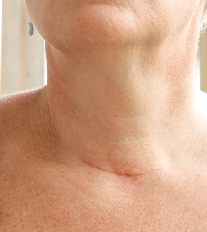 Una mujer mayor, sonriente, con una cicatriz postoperatoria después de una cirugía de la tiroides, primer plano