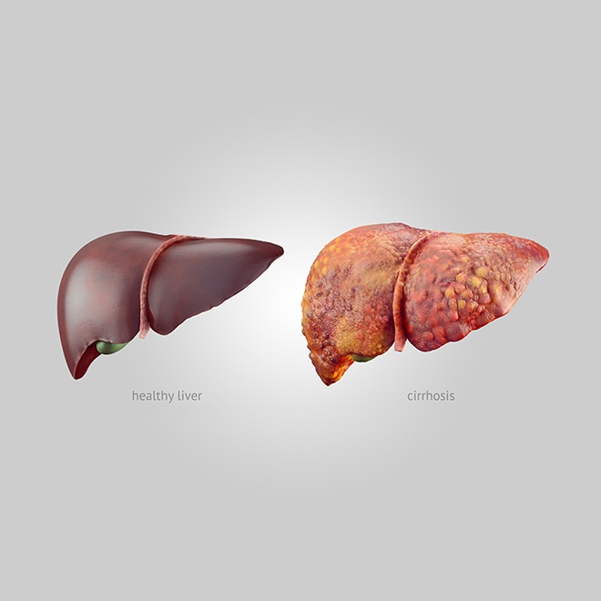 Realistic illustration of comparison of healthy and sick (cirrhosis) human livers