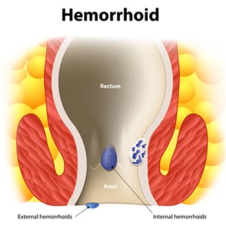 Diagram of internal and external hemorrhoids