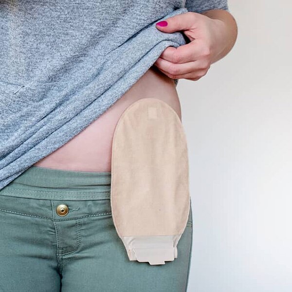 A woman with an ostomy pouch hanging from a stoma on the left side of her belly.