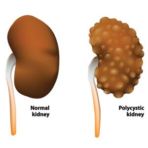 Normal and polycystic kidneys comparison image
