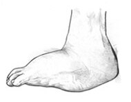 Ilustración del pie de Charcot que presenta un ensanchamiento de la planta del pie en forma redondeada.