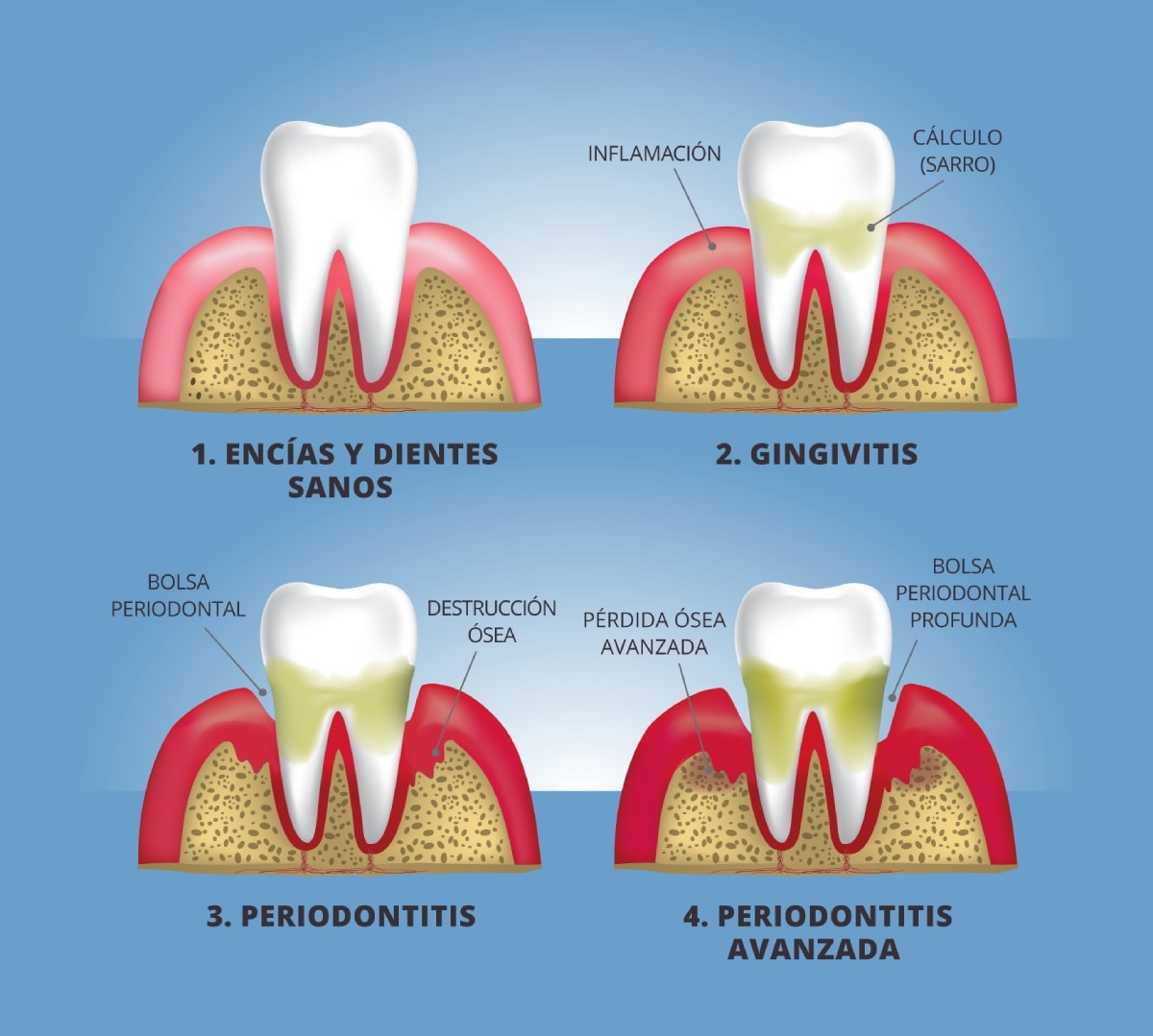 Ilustración en primer plano de un diente y encías, mostrando cuatro etapas de la enfermedad de las encías: (1) encías y diente sanos, (2) gingivitis, (3) periodontitis y (4) periodontitis avanzada.  Las etiquetas señalan:  inflamación, cálculo (sarro), bolsa periodontal, destrucción ósea, pérdida ósea avanzada y bolsa periodontal profunda.