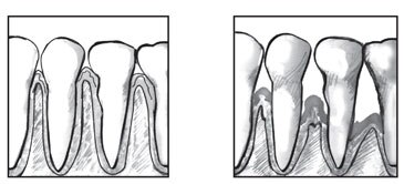 Dibujo de una vista cercana de los dientes y las encías sanas de una persona. Dibujo de una vista cercana de los dientes y las encías de una persona con periodontitis.