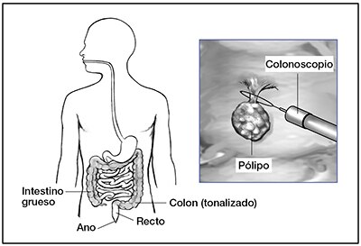 Ilustración de un torso, centrándose en el intestino, ano, recto y colon. ilustración más pequeña de un pólipo de colon siendo eliminado