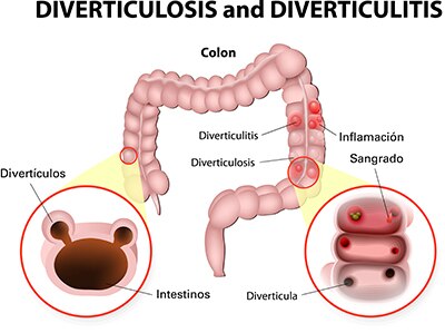 Ilustración de los dos puntos con la inflamación, sangrado, la diverticulosis y la diverticulitis