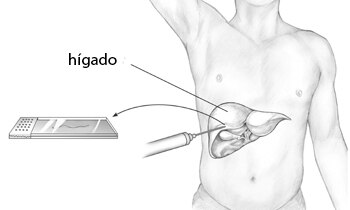Dibujo de un procedimiento de biopsia del hígado. Aparece el dibujo del hígado dentro del contorno de un cuerpo masculino. Una aguja pincha un trozo de tejido hepático. Una flecha señala el punto en el que la aguja toca el hígado y se dirige a un portaobjetos con la muestra de tejido. El hígado está etiquetado.