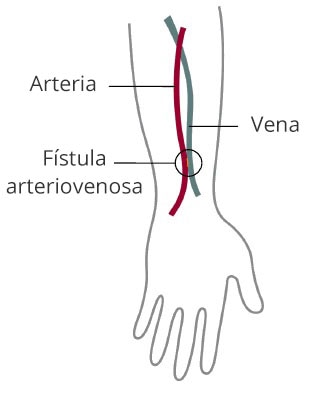 Dibujo de un brazo que muestra una fístula arteriovenosa que conecta una arteria y una vena.