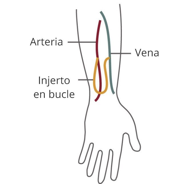 Dibujo de una vena y una arteria en un brazo conectada por un injerto en bucle.