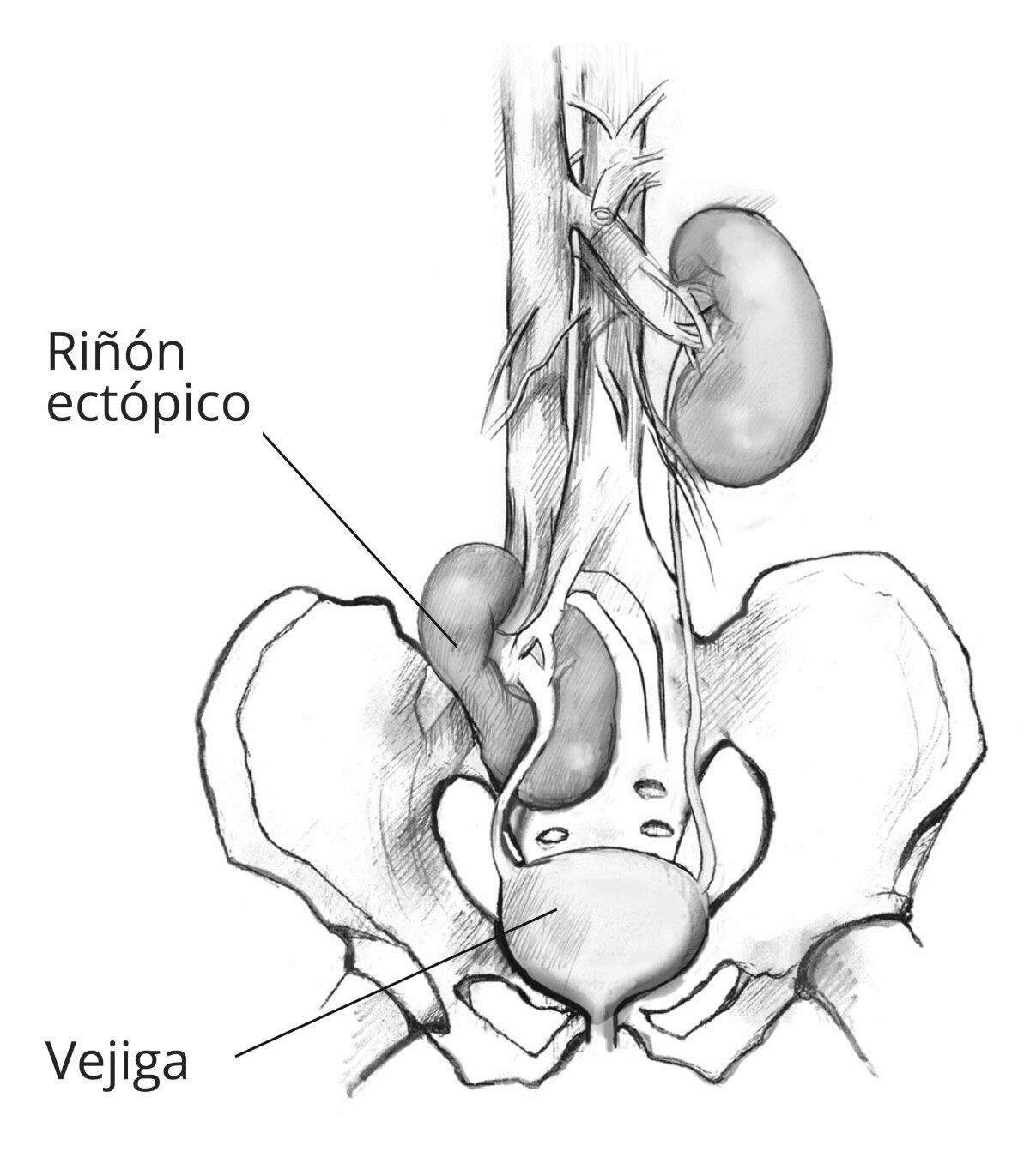 Un riñón ectópico y las estructuras internas circundantes.