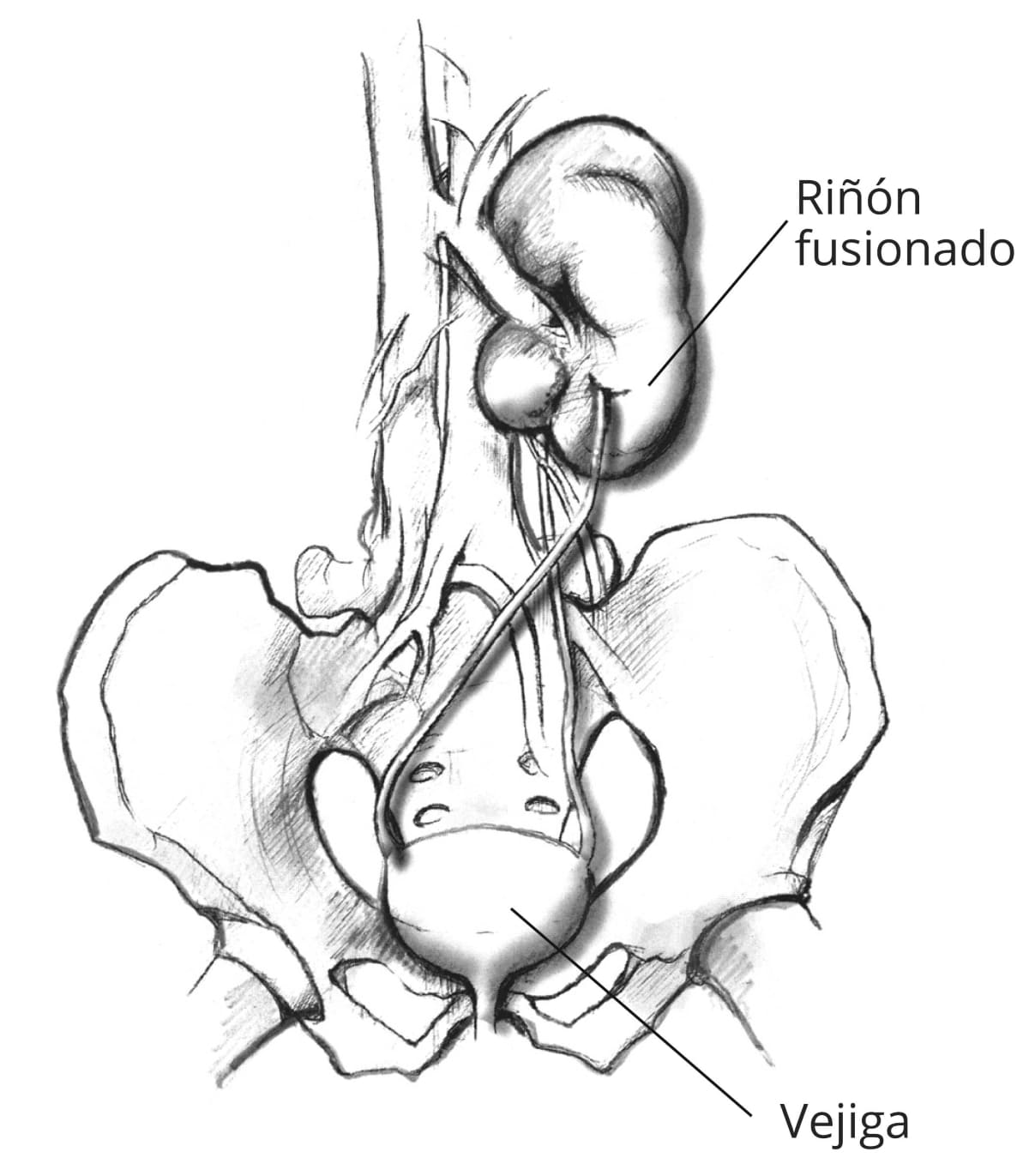 Un riñón ectópico fusionado, mostrando la pelvis, la vejiga, los uréteres y los riñones unidos. El riñón que normalmente estaría a la izquierda cruzó al otro lado del cuerpo y se fusionó con el riñón de la derecha.