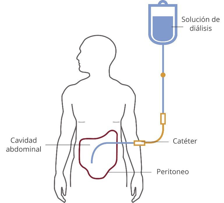 Ilustración de una persona en diálisis peritoneal. La solución de diálisis fluye de una bolsa a un tubo a través de un catéter y a la cavidad abdominal, que está delineada por el peritoneo.