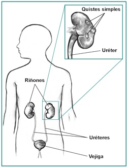 Conducto urinario de una figura masculina, con un recuadro que muestra unos quistes renales simples