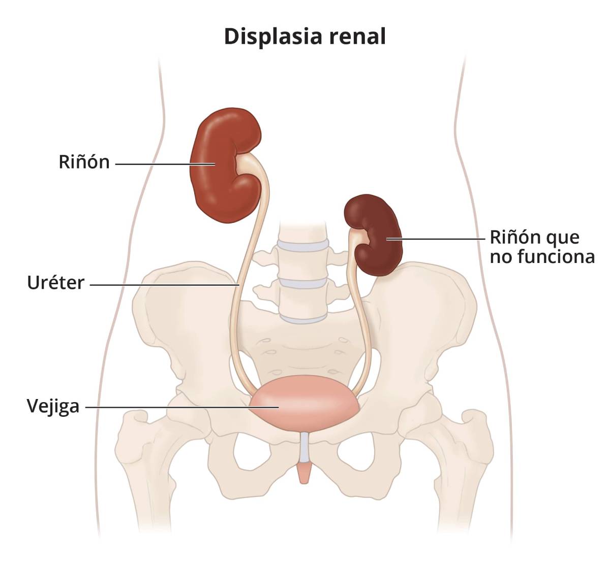 La ilustración muestra un riñón sano, un riñón que no funciona, dos uréteres y la vejiga.