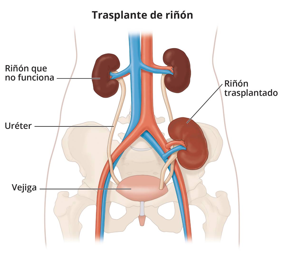 Dibujo de un riñón y uréter trasplantados en relación con el tracto urinario y el suministro de sangre.
