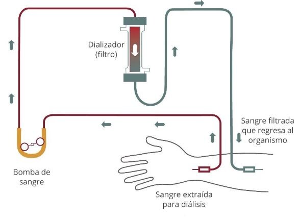 Diagrama del flujo sanguíneo de la hemodiálisis que va del brazo a un tubo y pasa por una bomba de sangre hasta el filtro. La sangre filtrada regresa al brazo.