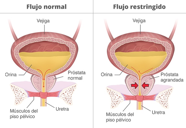 Dos vejigas que muestran un flujo de orina normal frente a uno restringido como consecuencia de una próstata agrandada y una constricción de la uretra.