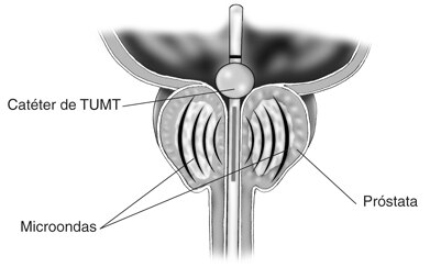 Ilustración de la sección transversal de la próstata, vejiga y uretra. Un catéter para termoterapia transuretral por microondas (TUMT, por sus siglas en inglés) está en la uretra. El catéter se extiende hacia dentro de la vejiga. Un globo pequeño inflado cerca del final del catéter lo mantiene en su lugar. Las líneas curveiformes representan los microondas que emanan del catéter y viajan a través de la próstata. Se señala el catéter TUMT, los microondas y la próstata.
