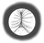 Ilustración del interior de la uretra, vista a través de un cistoscopio. Las paredes de la uretra están cerradas entre sí, dejando poco espacio para que la orina fluya.