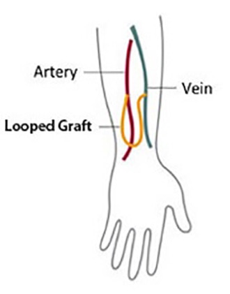Drawing of a vein and an artery in an arm connected by a looped graft.
