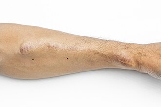 A person’s arm showing an AV fistula.