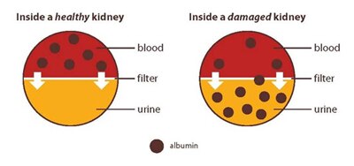 A diagram showing a healthy kidney with albumin only found in blood, and a damaged kidney that has albumin in both blood and urine.