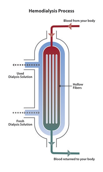 Diagram of blood flow from the top of the dialyzer to the bottom. Dialysis solution flows in the opposite direction, from bottom to top. Cross-section shows hollow fibers inside the dialyzer, where wastes pass from the blood into the solution.