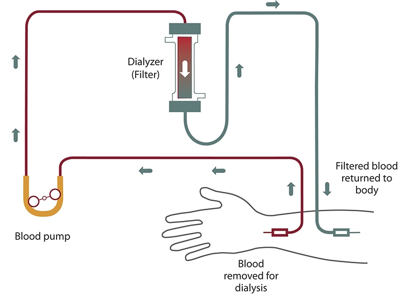 Diagram of hemodialysis blood flow from your arm into a tube and past a blood pump to the filter. Filtered blood flows back into your arm.