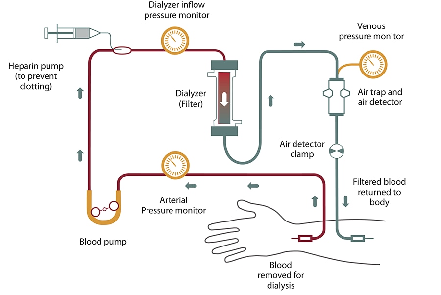 Diagram of hemodialysis blood flow from your arm into the tube, past a pressure monitor, a blood pump, and a heparin pump, which prevents clotting. Blood flows past another pressure monitor before entering the dialyzer, or filter. Filtered blood continues past a venous pressure monitor, an air trap and air detector, and an air detector clamp, and returns to your arm.