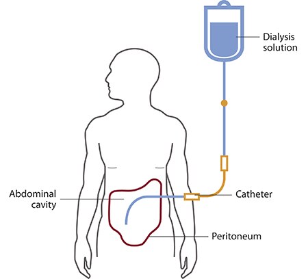 Illustration of a person having peritoneal dialysis. Dialysis solution flowing from a bag into a tube through a catheter and into the abdominal cavity, which is outlined by the peritoneum.
