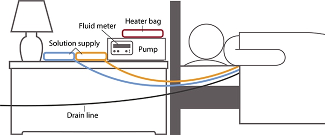 Drawing of person in bed next to a nightstand with a heater bag, fluid meter, pump, and two solution supply sources. Lines connect the solution supplies to the person. A drain line connects from the person and out of the frame of the drawing.