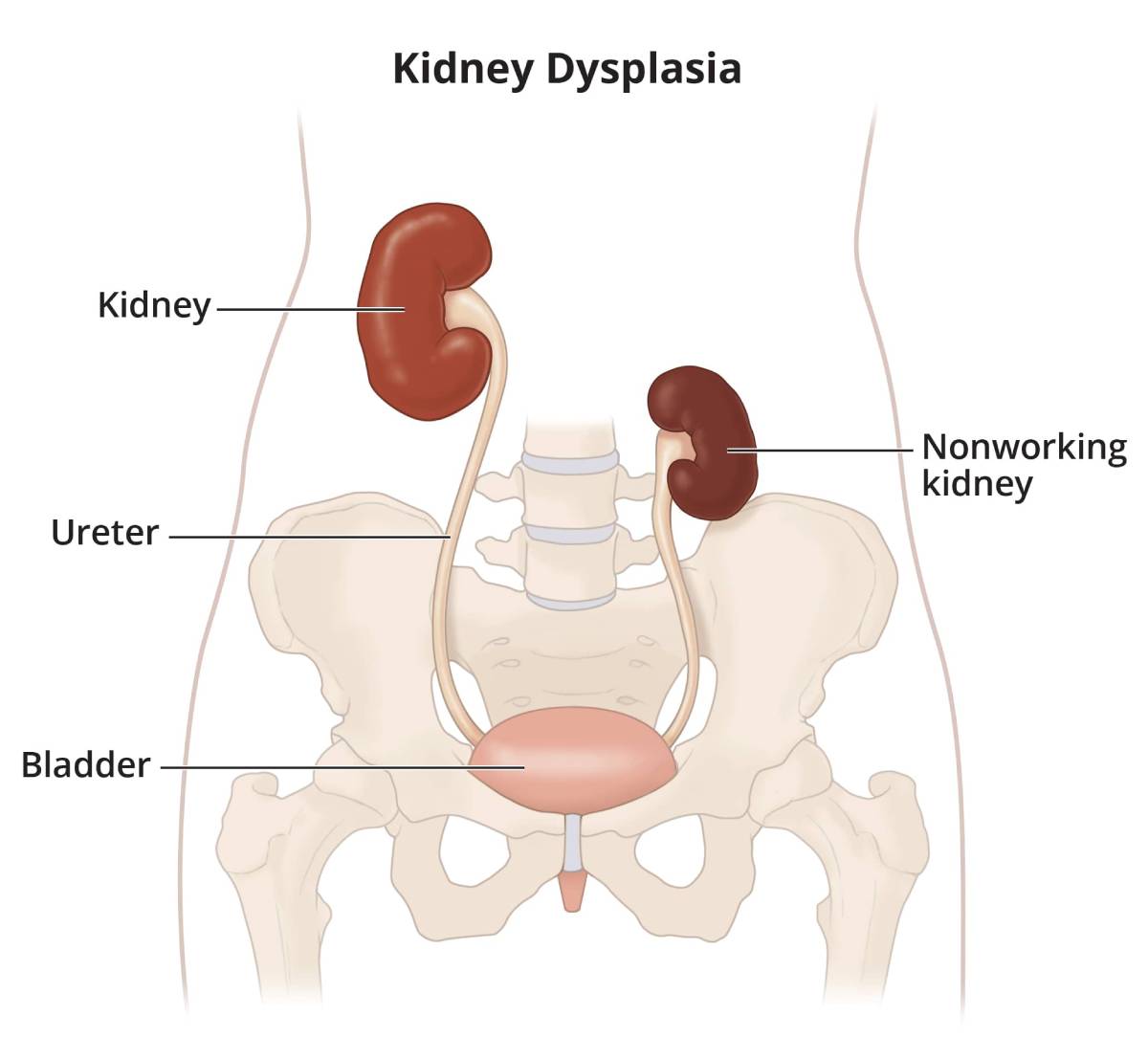 The illustration shows a healthy kidney, a nonworking kidney, two ureters, and the bladder.