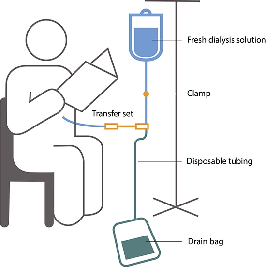 Drawing of a person reading during CAPD. A bag of fresh dialysis solution hangs from a pole and is connected to a tube that has a clamp. The tube connects to a transfer set, a disposable tube that connects to another tube that enters the person’s abdomen. Tubing also connects from the transfer set to the drain bag on the floor.