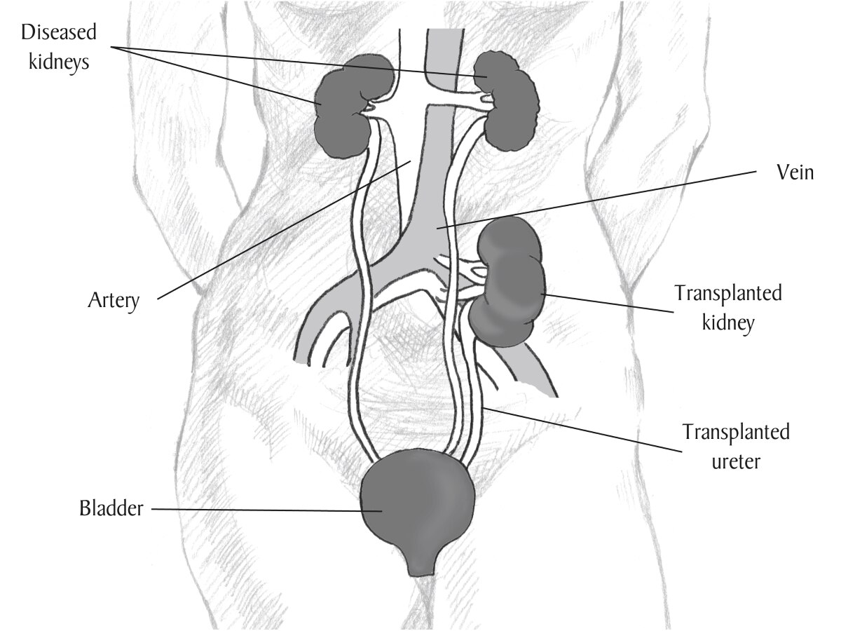 Diagram of a transplanted kidney.