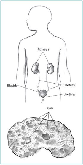 Drawing of a male torso with kidneys, ureters, bladder, and urethra labeled, and a drawing below of a kidney with sacs of fluid labeled as 
